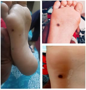 pictures-of-black-spots-on-soles-of-feet